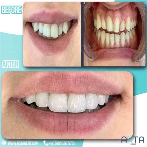 veneers in turkey reddit|Best Turkish Veneers: Veneers in Turkey At Best Price .